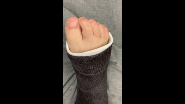Close Up Toe Wiggling in Short Leg Cast video from Missi Minks
