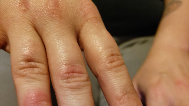 Eczema On My Hands video from RentRiley